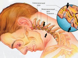 Физические упражнения для шейного отдела позвоночника