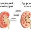 Хронический пиелонефрит: что это и чем лечить?