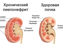 Хронический пиелонефрит: что это и чем лечить?