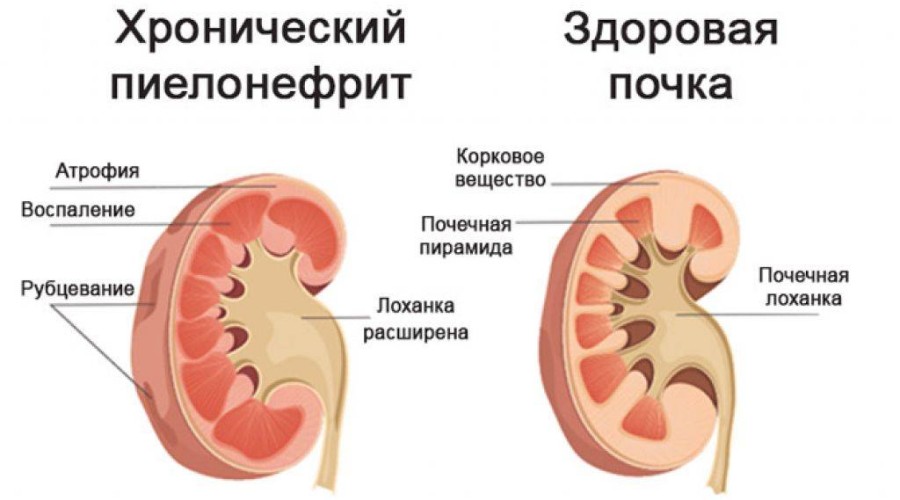 Хронический пиелонефрит: что это и чем лечить?